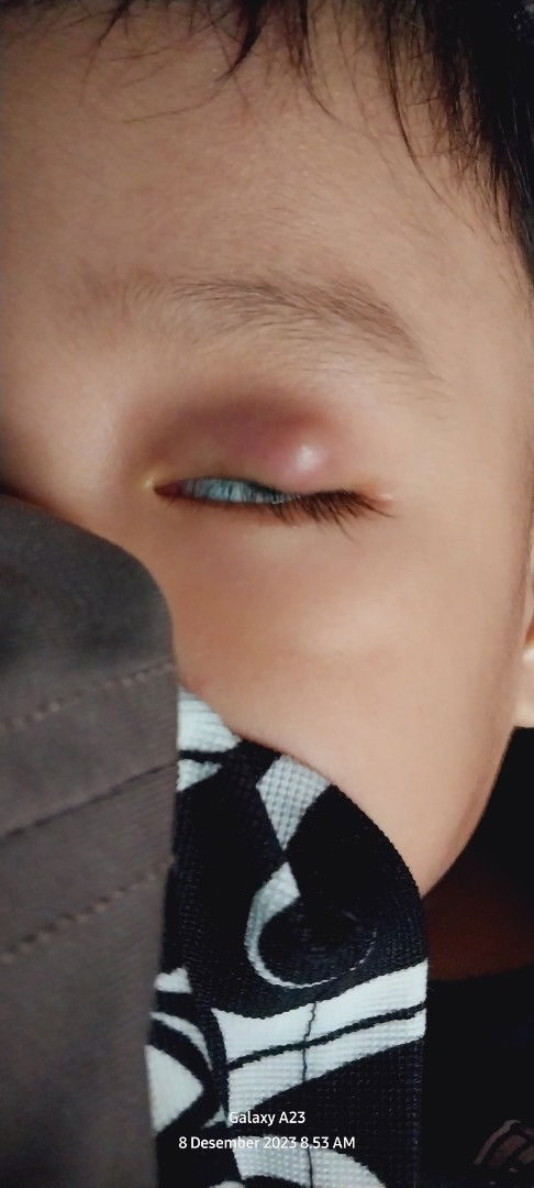 Kelopak mata bengkak