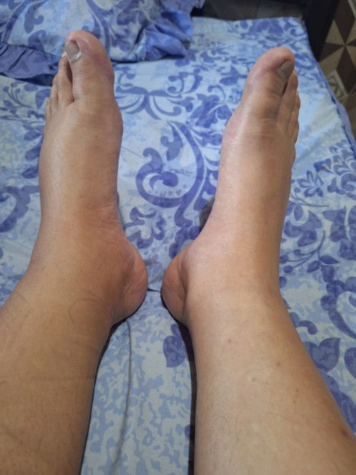 Kaki bengkak di usia kehamilan 20 minggu