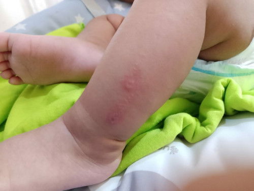 Bayi 3 bulan tiba" muncul luka seperti herpes, kira" pakai obat apa ya bund?