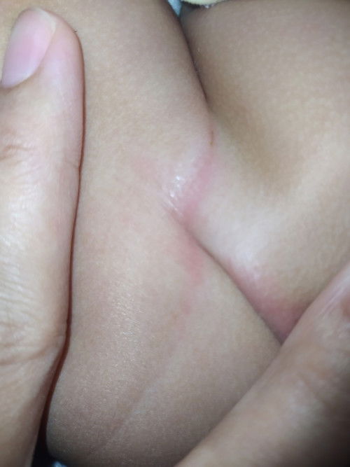 Lecet pd selangkangan bayi