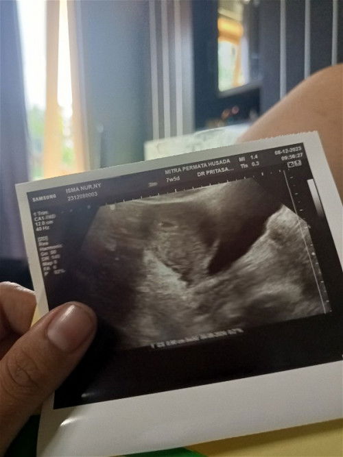 Keluar flek,di usg keguguran