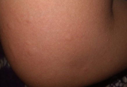 Hamil 5 minggu gatal"