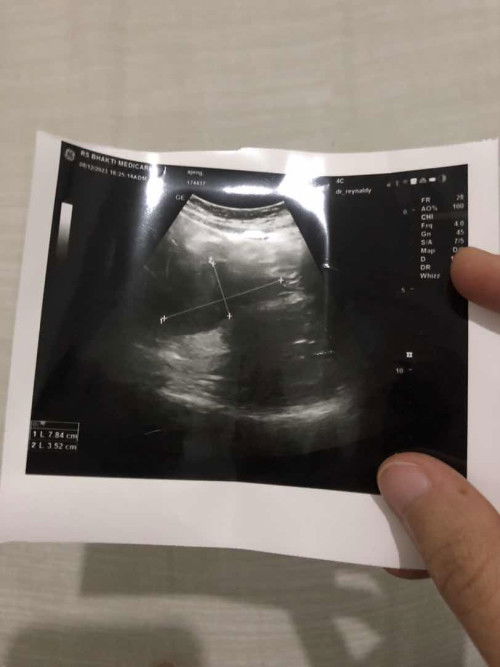 Rencana promil setelah keguguran berulang