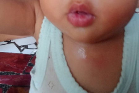 Bibir bayi sariawan