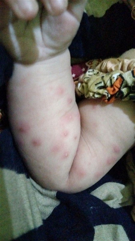 Bayi full ASI gatal-gatal/bisul