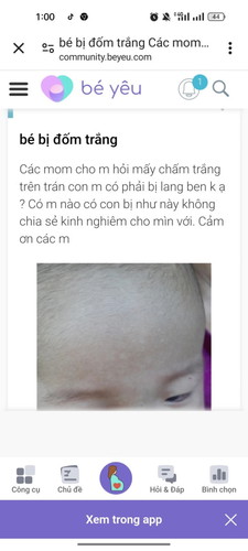 Các mom ai biết về bệnh đốm trắng trên trán bé như thế này.bé nào bị vậy biết thichỉ giúp mình với ạ