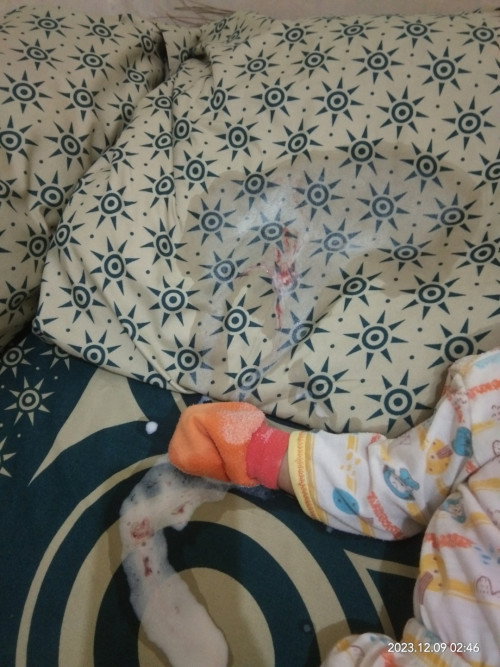 Muntah bercampur darah setelah minum susu formula