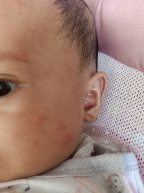 Bekas gigitan nyamuk