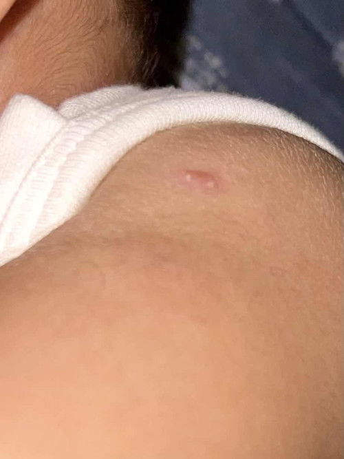 Biji mata pada BCG baby