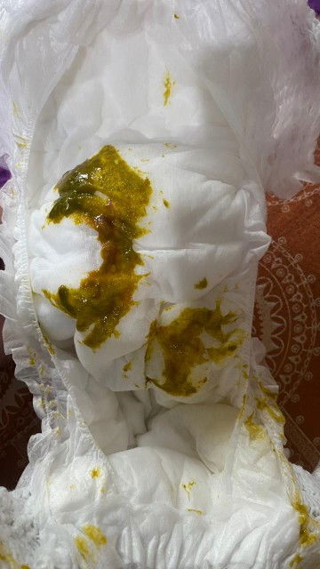 Maaf bun anak sy usia 5buln 10 hari baru sja fase bab sperti ini ada sdikit kya becak darah. Knp y