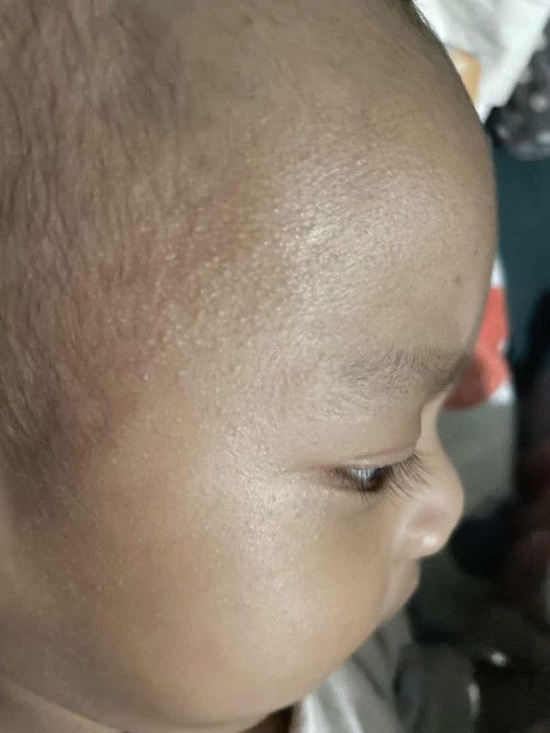 Seperti beruntusan di kepala bayi 5 bulan