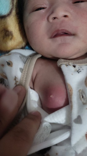 Ada yang bayi nya ngalamin sprti ini gak mam 🥲. Tiba tiba di bagian payudaranya bengkak