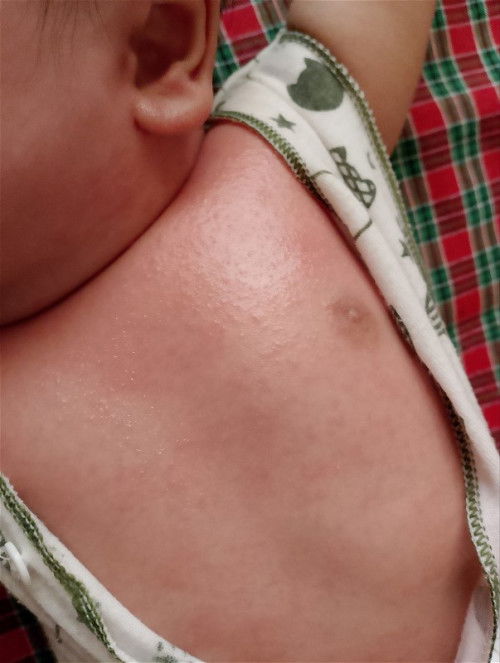 Kulit bayi beruntusan merah dan kulit kasar kalau diraba