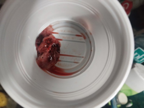 Miscarriage