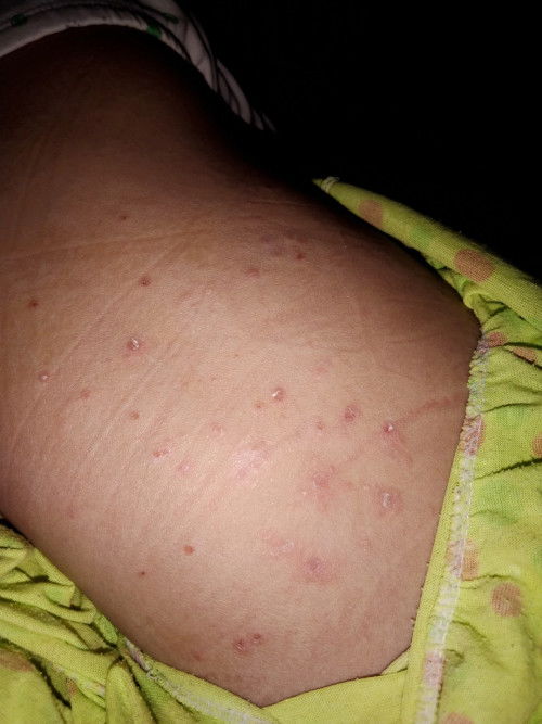 bintik pada punggung