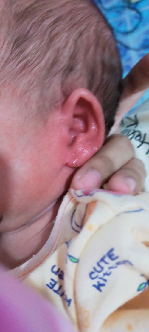 ใบหูหลังหูมีน้ำเหลืองซึม