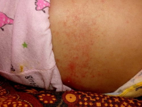 Biang keringat atau ruam