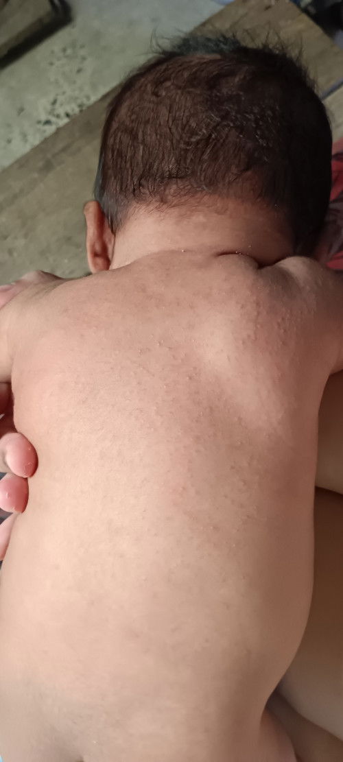 ลูกขึ้นผื่นแบบนี้ทำไงถึงจะหายค่ะ