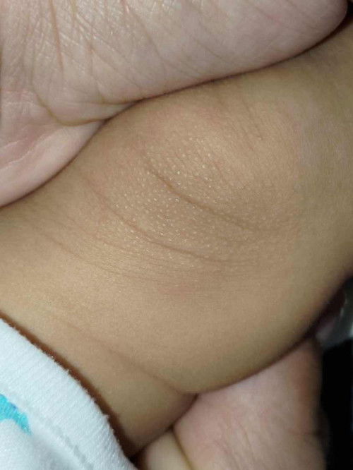 ผดผื่นตรงหัวเข่า