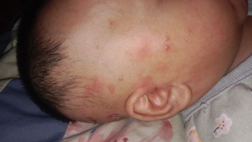 Merah2 muka dan kepala