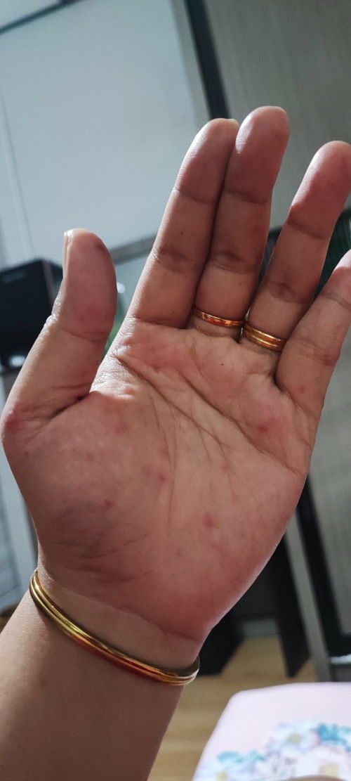 Bintik bintik pedih di tangan dan jari