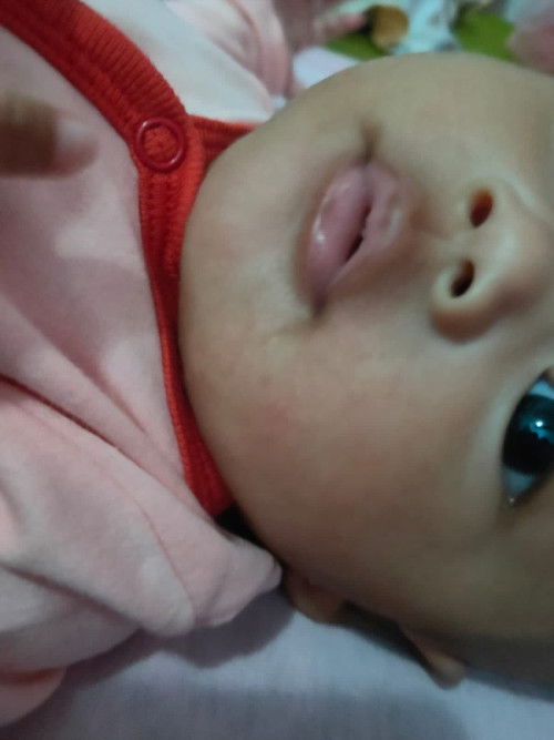 Iritasi merah dipipi