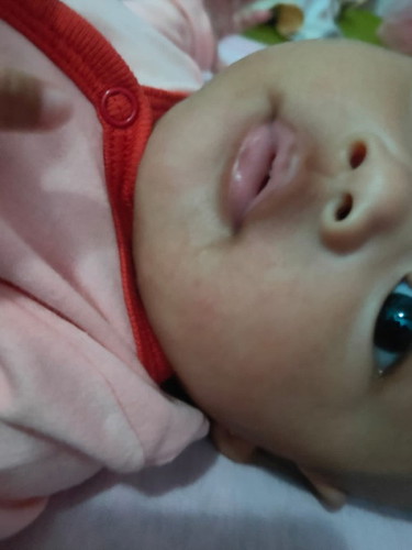 Iritasi merah dipipi