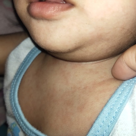 Rash after fever