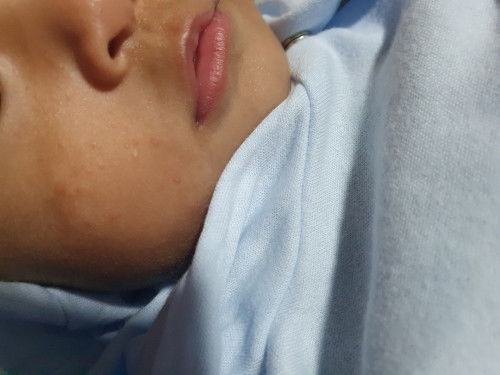 Infantile Acne po ba ito?