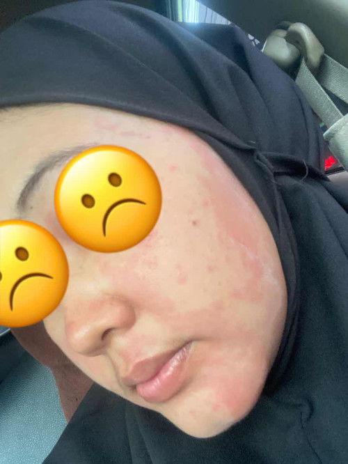 Ruam merah dikulit/Kaligata/biduran