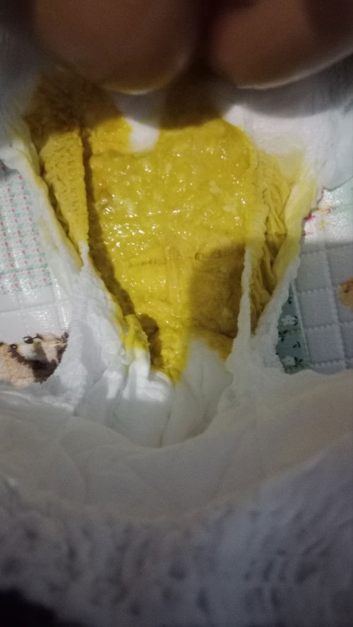 Bayi 4 bulan diare, 1 hari bab 5 kali