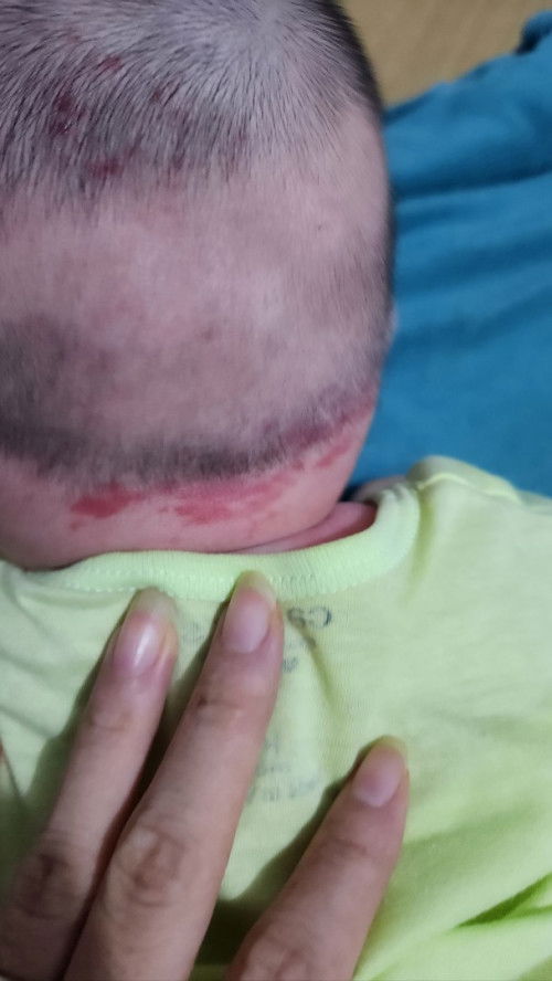 Vết đỏ sau đầu