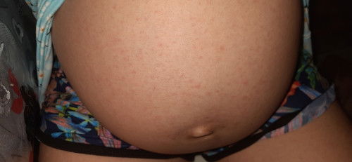 SINO PO NAKAEXPERIENCE NG HEAT RASHES DURING PREGNANCY DITO?