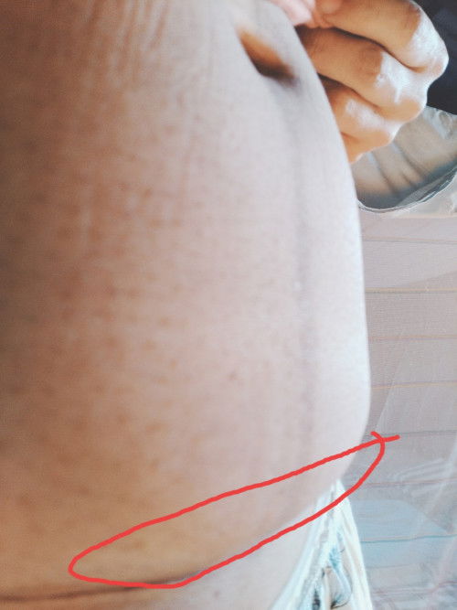 อยากถามเเม่ๆหลังคลอดค่ะคลอดน้องได้1เดือนกับ6วันเจ็บเหนือเเผลที่ผ่า เจ็บเเละเเดงกี่วันถึงจะหายค่ะ