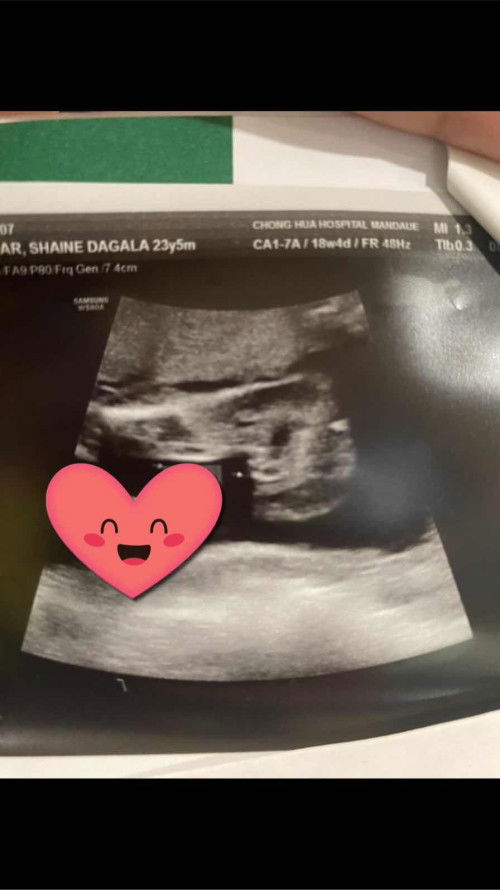 Gender at 18W4D