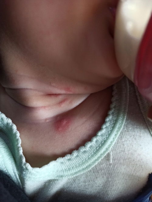 Bun ada yg tau ini kulitnya knp? Ini bukn biang kringat,,ksian dede nya nangis trus,,