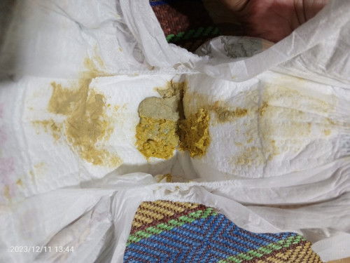 ask lang po kung normal ung stool bottle feed po..