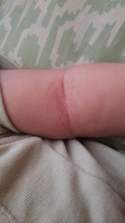 Mengatasi biang keringat