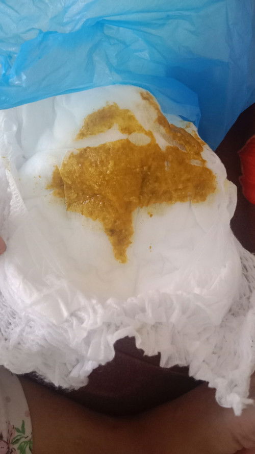 Sdkit jrok
Maf bun anak sya diare tpi fase ya sperti ini. Sdh sya ke DSA
Apa fase sprti ini berbahya