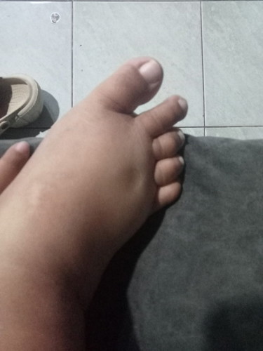 ขาบวมกดแล้วบุ๋ม