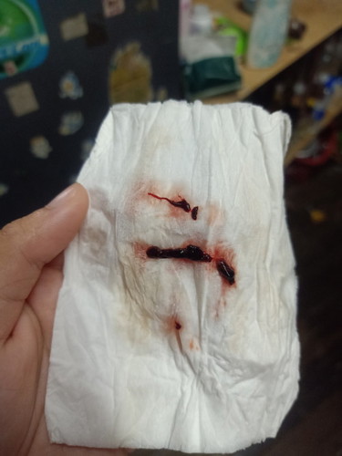 ฉีดยากันเเท้งยังมีเลือดออก