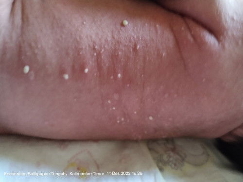 Seluruh badan ruam merah dan ada yang bernanah