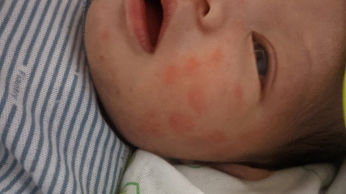 BINTIK MERAH DI PIPI NEW BORN