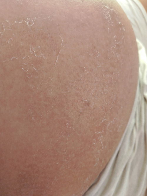 สอบถามค่ะ ท้องลอกควรทำยังไงดีคะ