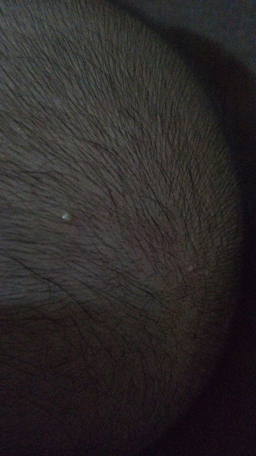 Jerawat dikepala bayi