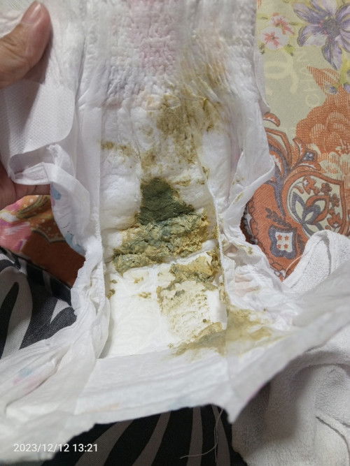 Ask lang po kung normal po ung ganitong dumi ni baby? bottle feed po