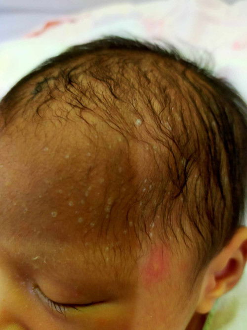 มีผื่นแบบนี้ขึ้นที่ศรีษะน้องคะ น้องคลอดได้ 9 วัน ผื่นเพิ่มขึ้นคะ เป็นอันตรายไหมคะ ต้องทำยังไงคะ