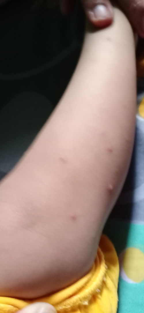 Maaf  dok mau tanya..
Tangan dan kaki anak saya tumbuh bentol seperti ini .