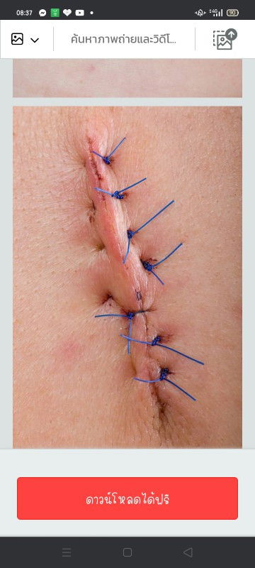 ไหมละลายผ่าตัด