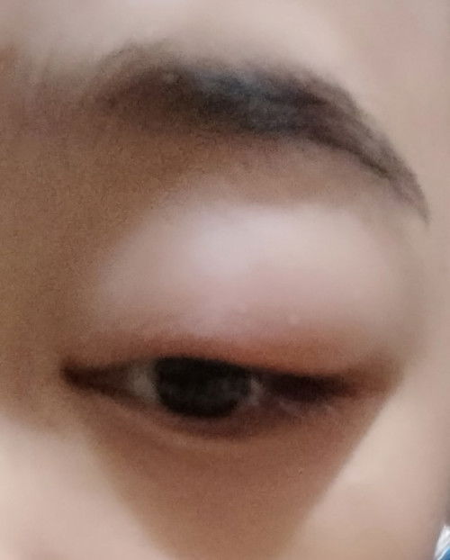 Rekomendasi salep untuk mata bengkak yang boleh untuk ibu hamil dong bun?